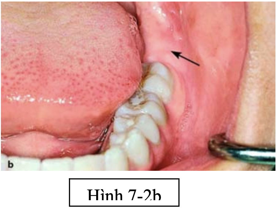 Phẫu thuật lấy mầm răng